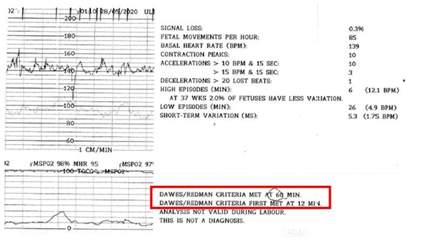 Exempel på utskrift vid datoriserad CTG-registrering med D-R.