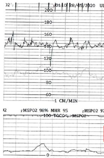 Exempel på hur variabiliteten mäts till 15 slag per minut.