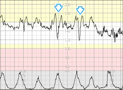 3 3 4 decelerationer